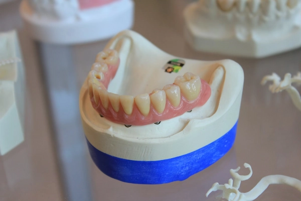 Prótesis dentales — coronas y puentes de porcelana